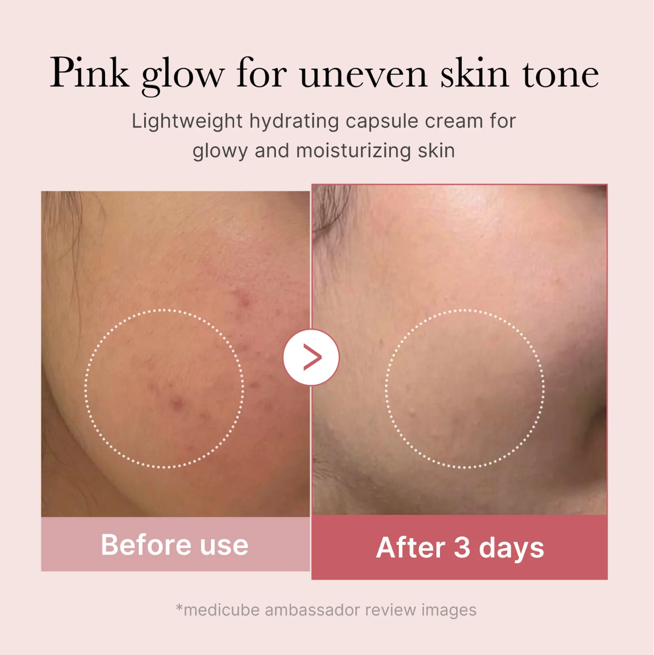 Medicube PDRN Pink Collagen Capsule Cream before and after – visible improvement in uneven skin tone and blemishes after 3 days of use