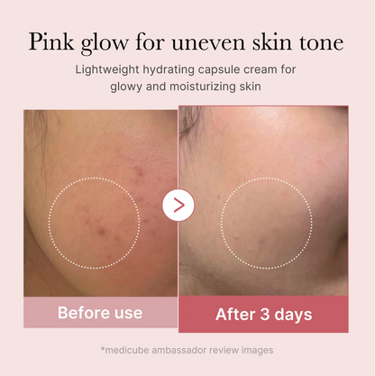 Medicube PDRN Pink Collagen Capsule Cream before and after – visible improvement in uneven skin tone and blemishes after 3 days of use